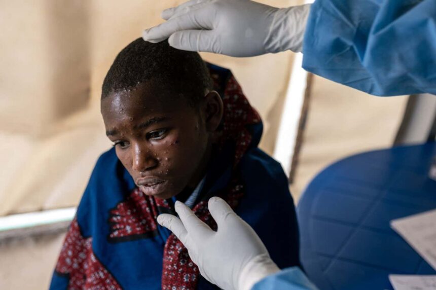 Mpox: How deadly is the virus and what treatments are available?