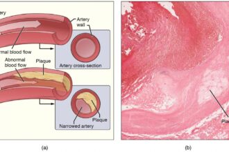 Metals in the body from pollutants associated with progression of harmful plaque buildup in the arteries