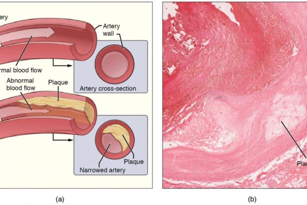 Metals in the body from pollutants associated with progression of harmful plaque buildup in the arteries