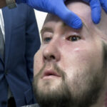 A man who received an eye and partial face transplant is examined by a doctor