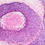 A microscope image of ductal carcinoma in situ