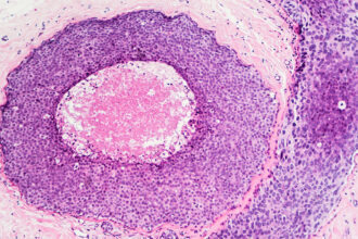 A microscope image of ductal carcinoma in situ