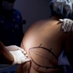 Bariatric surgery rates plunge as patients turn to GLP-1 drugs