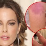 Kate Beckinsale Implies She's Doing Own Stunts, Posts Gruesome Injury Pics