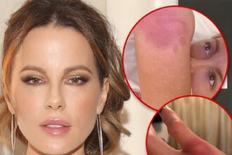 Kate Beckinsale Implies She's Doing Own Stunts, Posts Gruesome Injury Pics