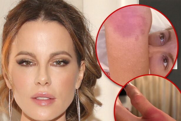 Kate Beckinsale Implies She’s Doing Own Stunts, Posts Gruesome Injury Pics