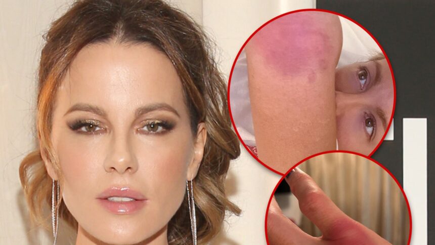 Kate Beckinsale Implies She's Doing Own Stunts, Posts Gruesome Injury Pics