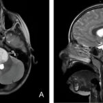 CAR-T therapy shows promise for 'worst imaginable' brain tumor