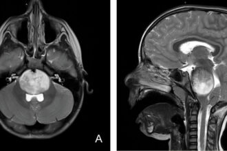 CAR-T therapy shows promise for 'worst imaginable' brain tumor