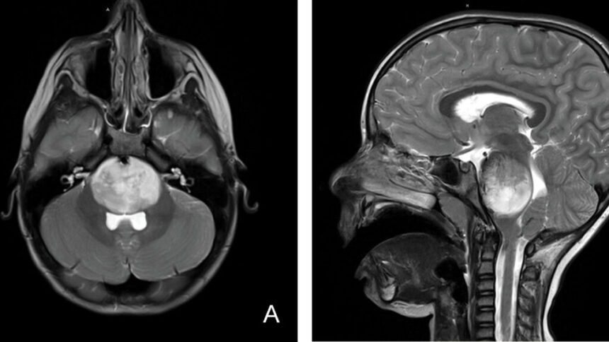 CAR-T therapy shows promise for 'worst imaginable' brain tumor