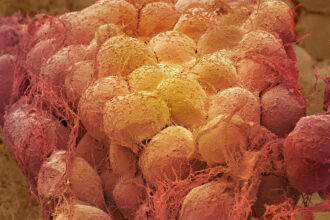 A scanning electron microscope image shows a close up of fat tissue in false color. The cells are rounded with strings of connective tissue attached.