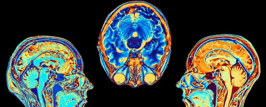 Type 2 Diabetes Linked to Accelerated Brain Shrinkage, Study Reveals : ScienceAlert