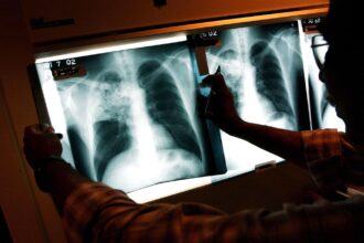 By 2040, Over 62.4 Million People In India Might Have Tuberculosis: Study