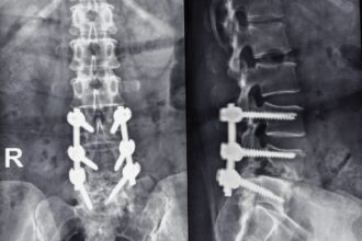 Luigi Mangione Said He Had Spondylolisthesis: What Is It?