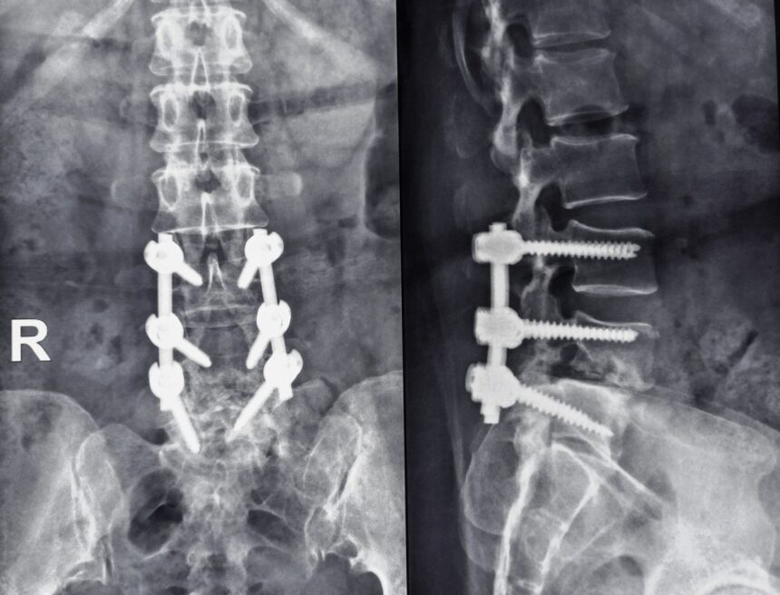 Luigi Mangione Said He Had Spondylolisthesis: What Is It?