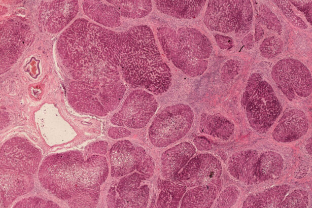 Liver disease’s progression halted by bariatric surgery in study