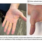 Man on carnivore diet develops yellowish nodules on his hands, feet and elbows