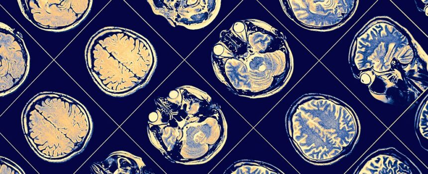 A Man Fated to Get Alzheimer’s Avoided It For Decades. But How? : ScienceAlert