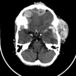 A New Approach To Childhood Neuroblastoma