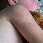 Texas Measles Cases Double Since Tuesday, Health Officials Report