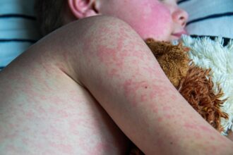 Texas Measles Cases Double Since Tuesday, Health Officials Report