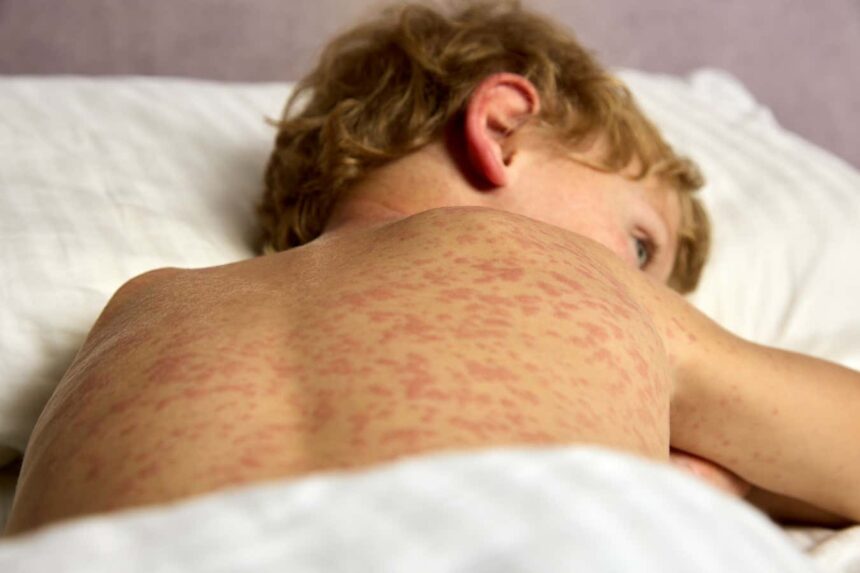Measles is spreading across the US – here is what you need to know