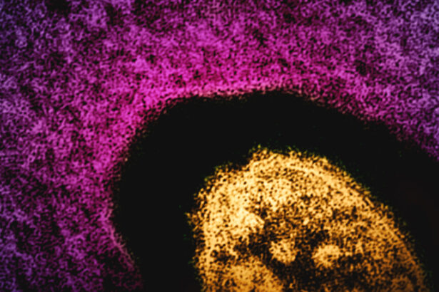 New Mexico adult dies with measles, though cause of death isn’t yet confirmed