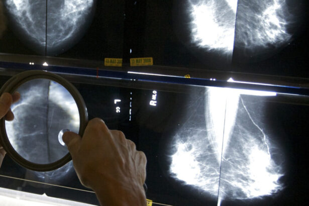 Advanced cancers returned to pre-Covid levels, report finds| STAT