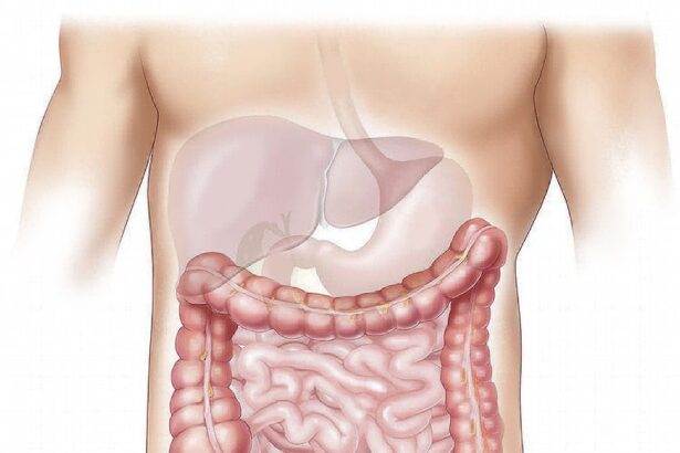 Clinical trial finds novel nutritional formula effectively treats gut microbial overgrowth