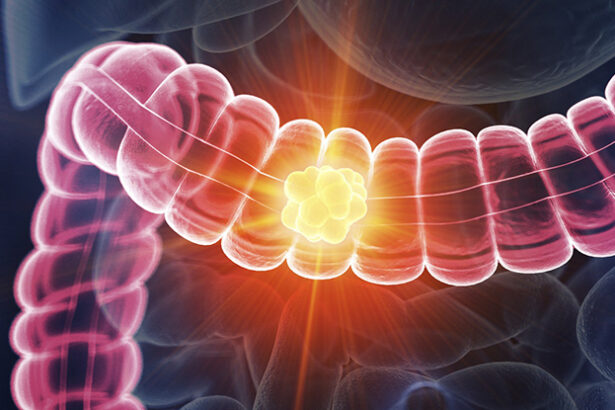 One Cancer Is Rising Rapidly in Younger People, And Bacteria Could Be Why : ScienceAlert