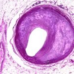 One-off gene-editing therapy could permanently lower cholesterol