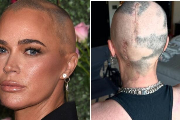 Teddi Mellencamp Shows Off Gruesome Scars From Brain Surgery