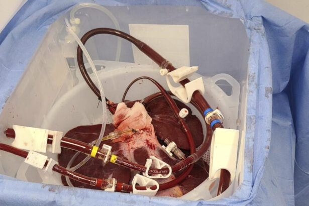 Trial of pig livers as dialysis-like treatment for liver failure cleared by FDA
