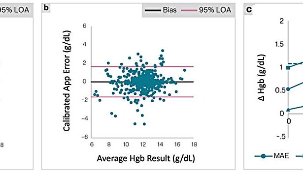 AI-powered app enables anemia screening using fingernail selfies