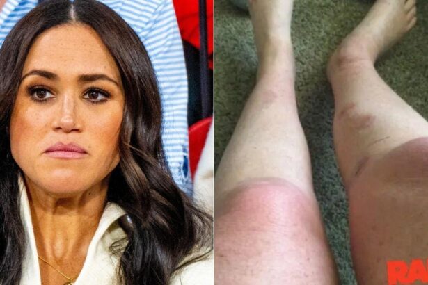 Burn Victim Claims Meghan Markle Knew About Labelling Responsibilities