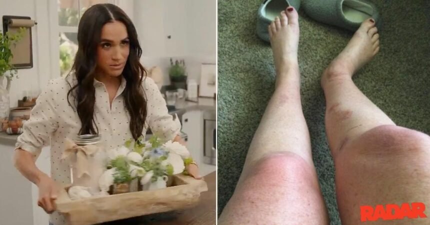 Meghan Markle Fan To Sue Duchess After Suffering ‘Catastrophic’ Burns’