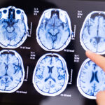 No, There Isn’t a Mysterious Brain Disease Spreading in Canada : ScienceAlert