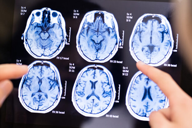 No, There Isn’t a Mysterious Brain Disease Spreading in Canada : ScienceAlert