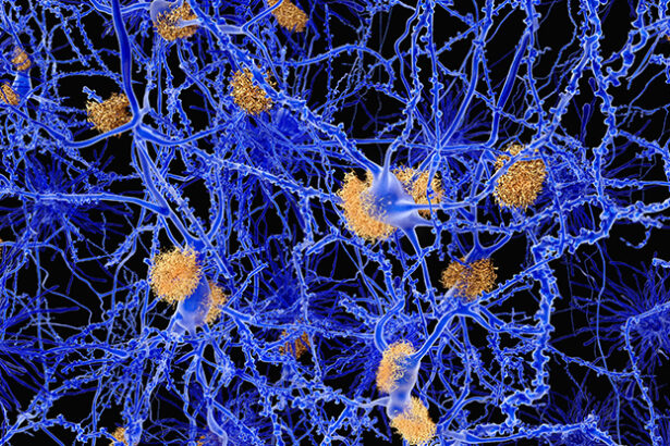 Sugar-Coated Particles May Protect Neurons From Alzheimer’s Disease : ScienceAlert