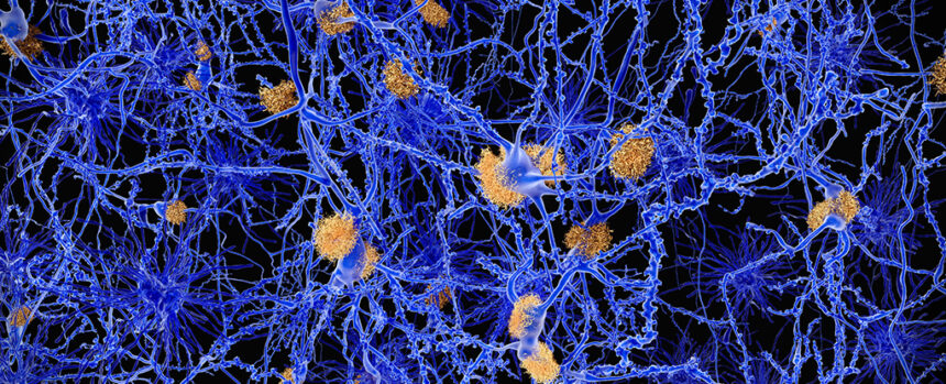 Sugar-Coated Particles May Protect Neurons From Alzheimer’s Disease : ScienceAlert