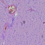 Alive two years after brain cancer diagnosis: CAR-T data raise hope