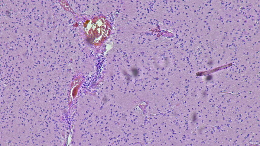 Alive two years after brain cancer diagnosis: CAR-T data raise hope