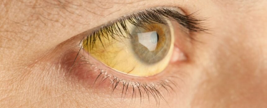 Compound That Turns People Yellow Could Protect Against Malaria : ScienceAlert