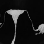 Growing push to remove fallopian tubes, lower ovarian cancer risk