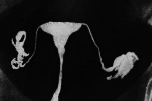 Growing push to remove fallopian tubes, lower ovarian cancer risk