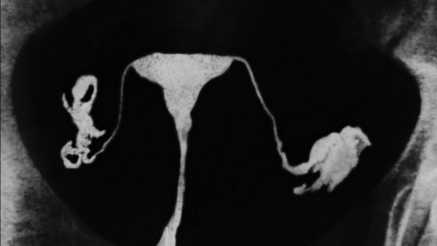 Growing push to remove fallopian tubes, lower ovarian cancer risk