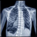 How Safe Is Spine Surgery? What To Know And What To Ask Your Surgeon