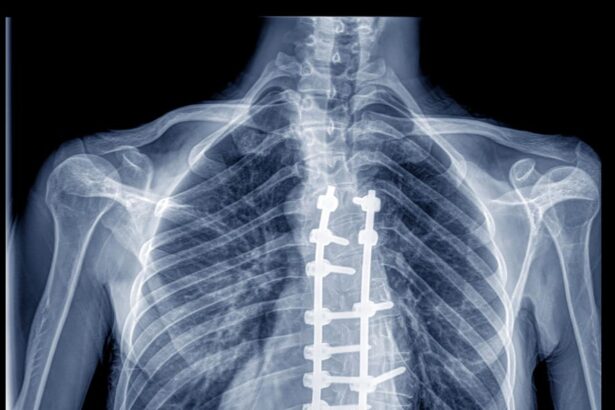 How Safe Is Spine Surgery? What To Know And What To Ask Your Surgeon