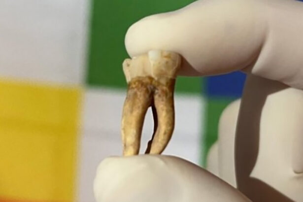 Leprosy Was Lurking in The Americas Long Before Colonization, Study Finds : ScienceAlert