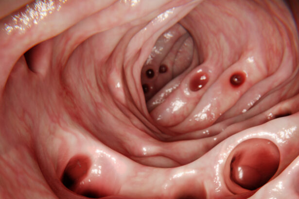 Most People Develop Diverticulosis in Their Gut by 80 … So What Is It? : ScienceAlert